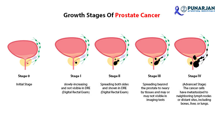 Best Prostate Cancer Treatment Hospital in India | Punarjan Ayurveda