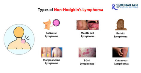 02 Types Of Lymphoma Cancer Copy 470x244 