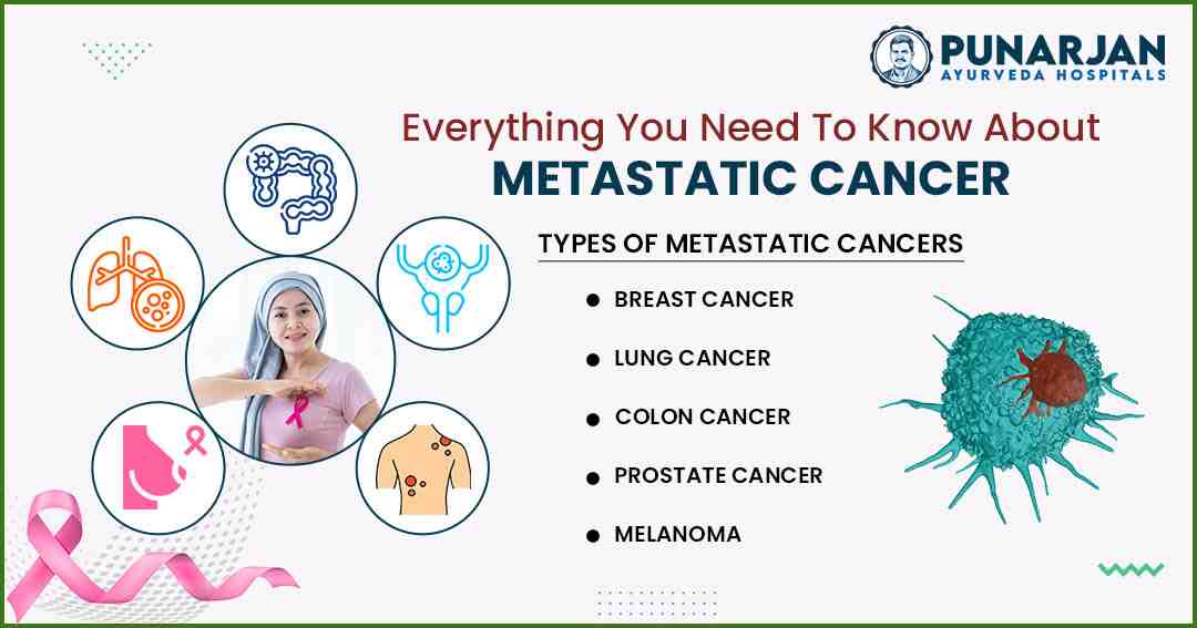 You are currently viewing Everything You Need To Know About Metastatic Cancer