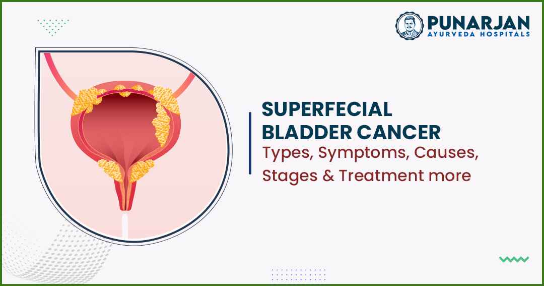 You are currently viewing Superficial Bladder Cancer: Types, Symptoms, Causes, Stages, Treatment And More