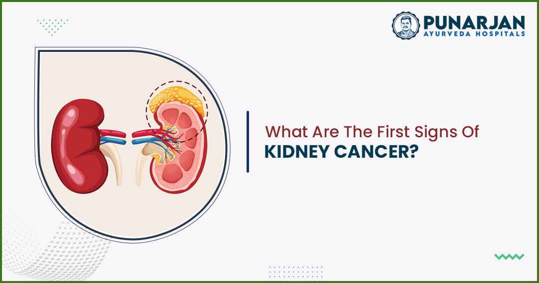 You are currently viewing What Are The First Signs Of Kidney Cancer?