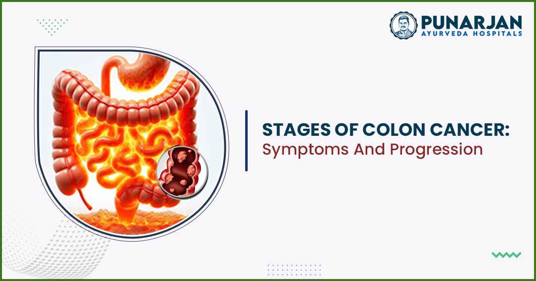 Stages Of Colon Cancer: Symptoms