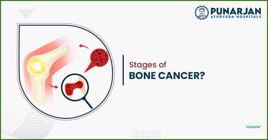 You are currently viewing Stages Of Bone Cancer