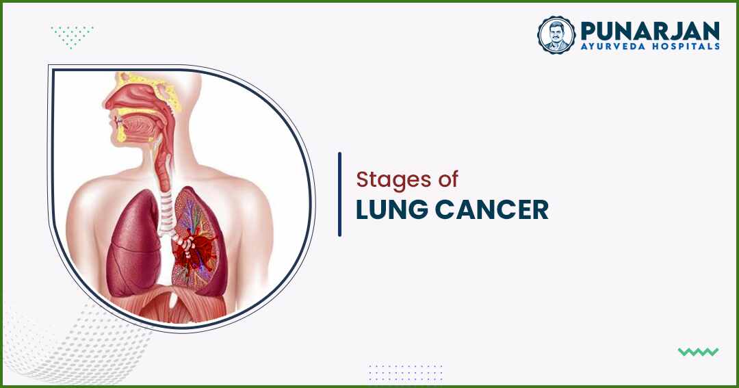 best lung cancer treatment hospital in hyderabad