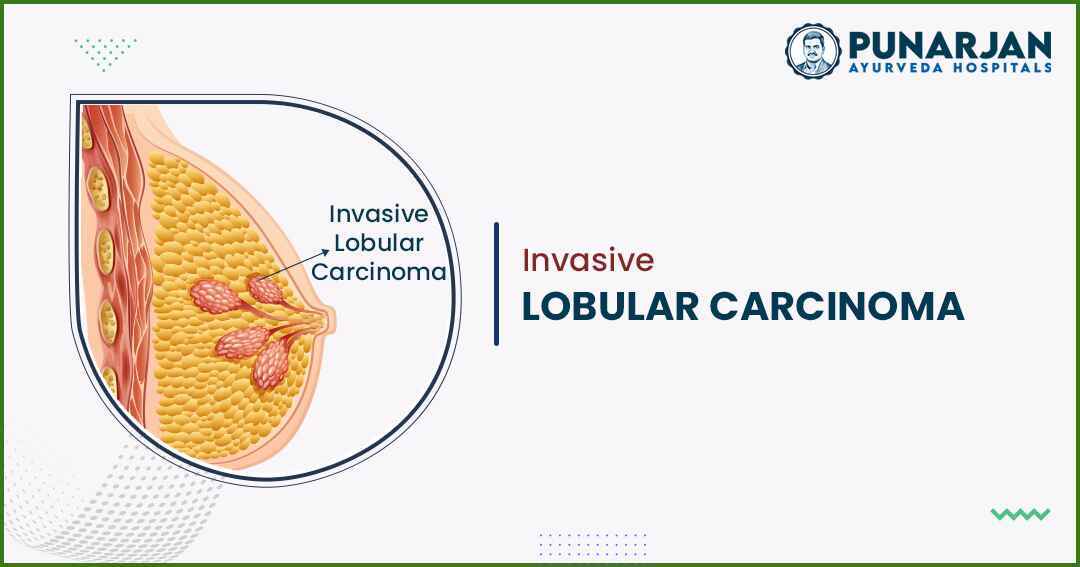 Invasive lobular carcinoma