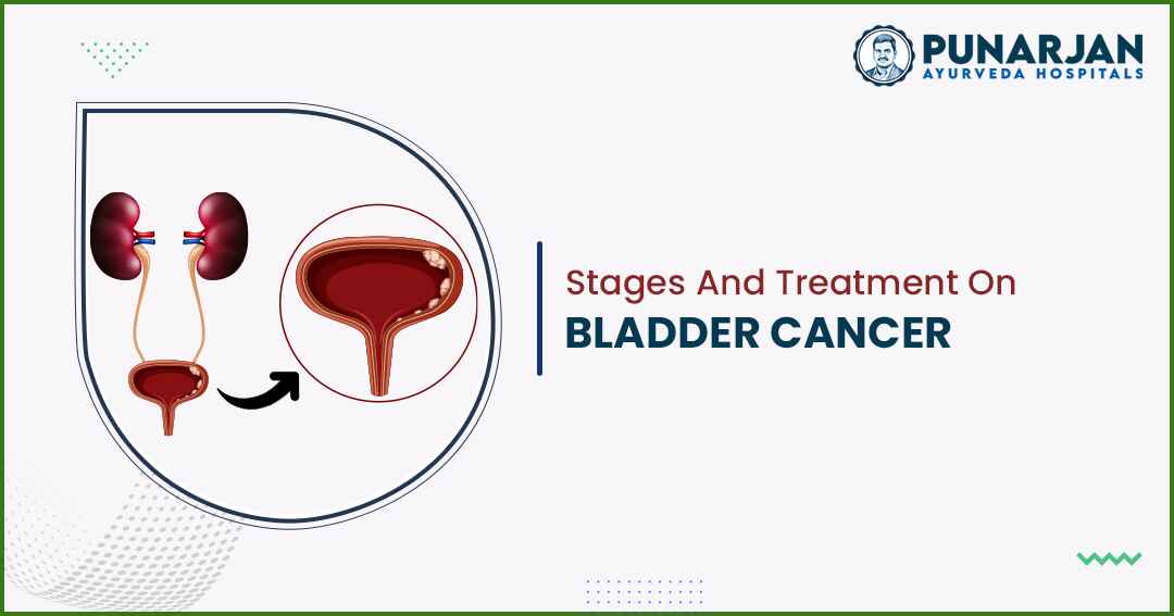 Stages And Treatment On Bladder Cancer