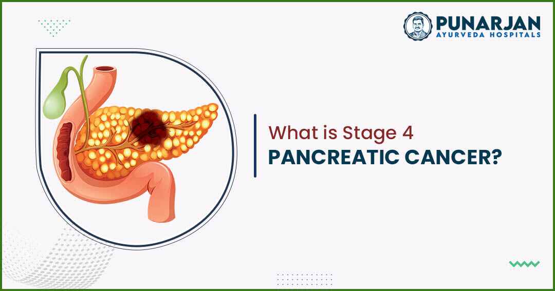 What Is Stage 4 Pancreatic Cancer