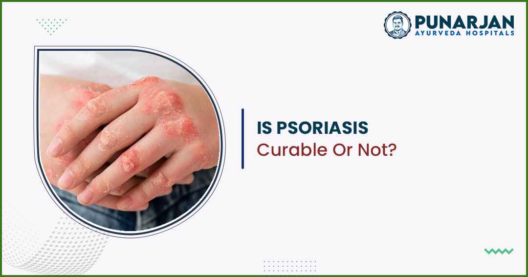 Is Psoriasis Curable Or Not?