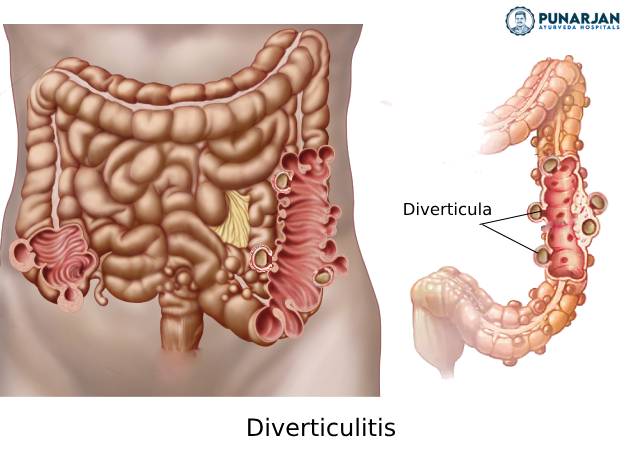 Diverticulitis