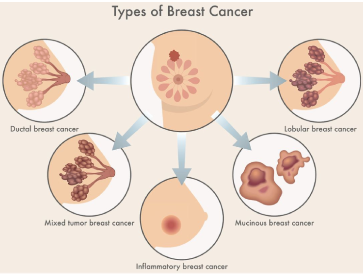 Breast cancer types