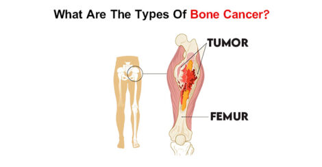 What-Are-The-Types-Of-Bone-Cancer