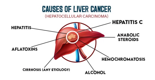causes-of-liver-cancer
