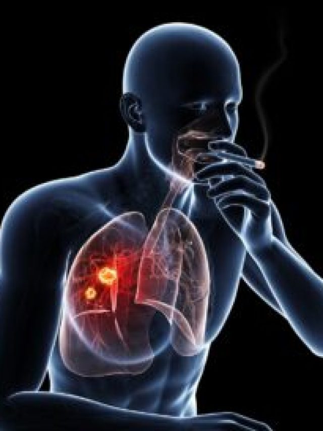 Lung Cancer Basics