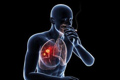 lung-cancer-due-to-smoking (2)