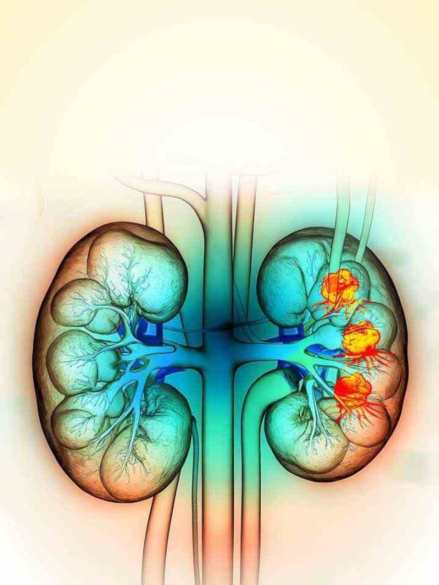 Preventive Measures To Lower Kidney Cancer Risk