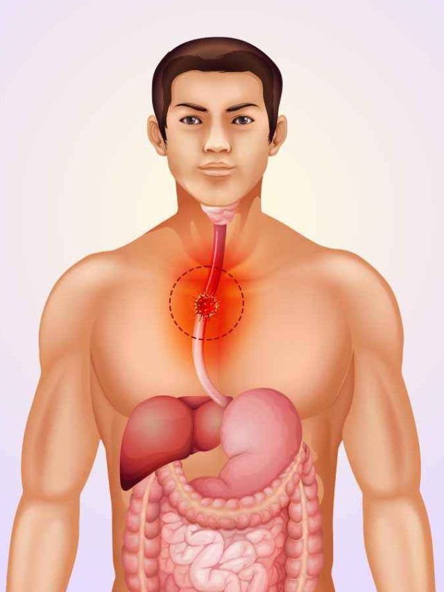 Warning Signs of Esophageal Cancer