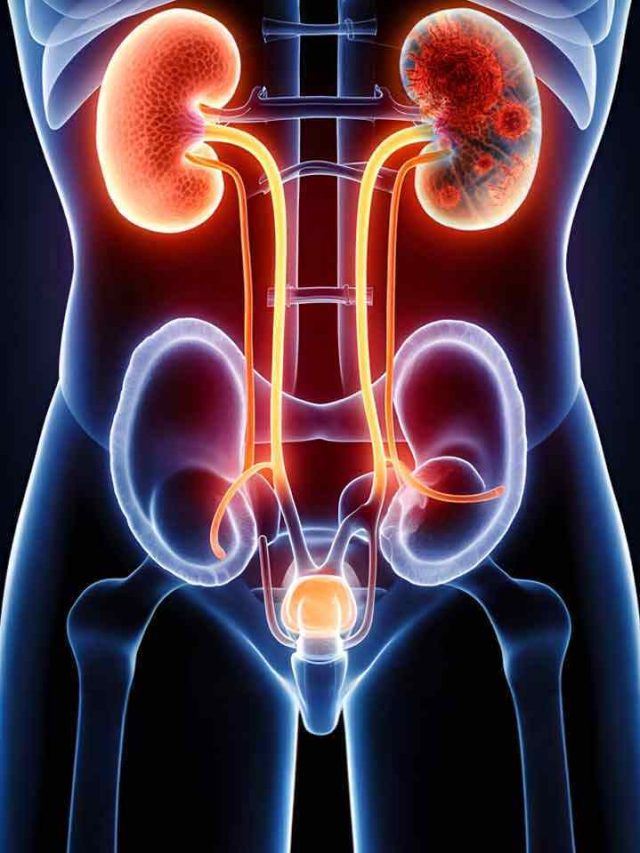 Don’t Ignore These Early Warning Signs Of Kidney Cancer