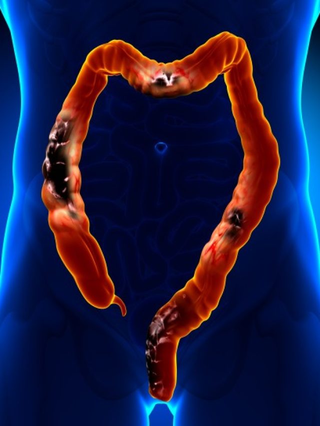 Colon Cancer is Increasing in Younger Adults: Here are 5 Signs to Look Out For