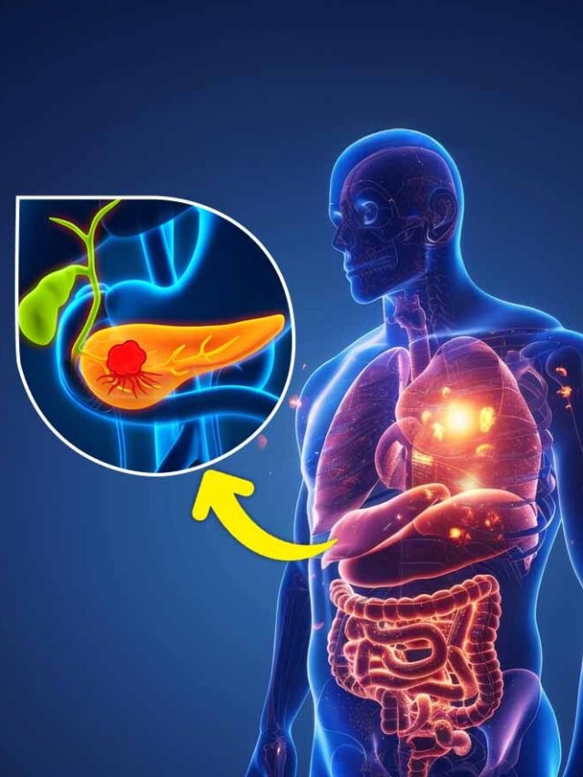 Early Signs of Pancreatic Cancer