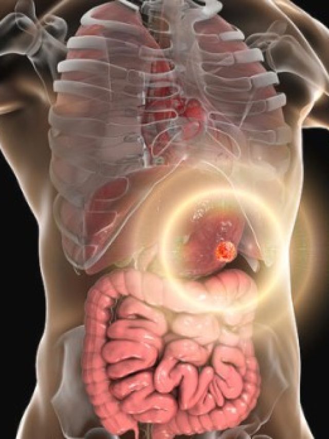 Recognizing Early Symptoms of Stomach Cancer