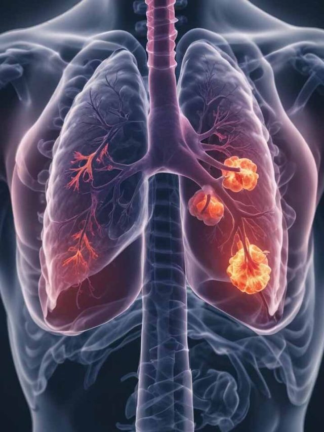 Lung Cancer Signs: Know When to Be Concerned