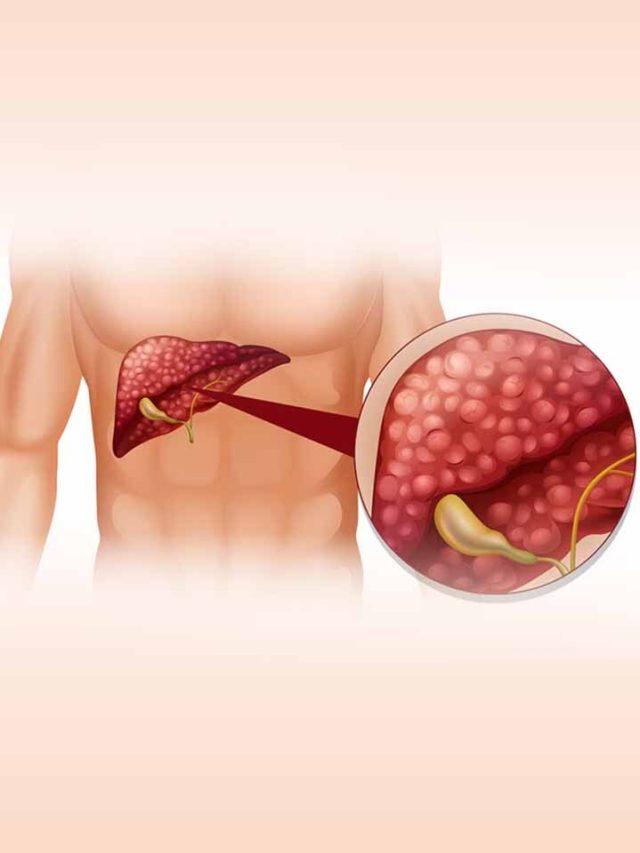 How Fatty Liver Cause Skin Cancer Symptoms..?