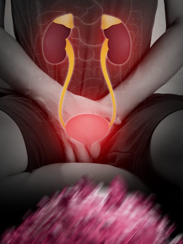 Top 4 Treatments for Bladder Cancer 